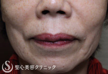【60代女性・ほうれい線の若返り】プレミアムPRP皮膚再生療法（8ヶ月後） After 
