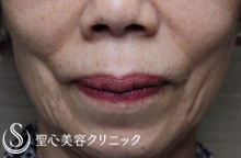 【60代女性・ほうれい線の若返り】プレミアムPRP皮膚再生療法（8ヶ月後） Before 