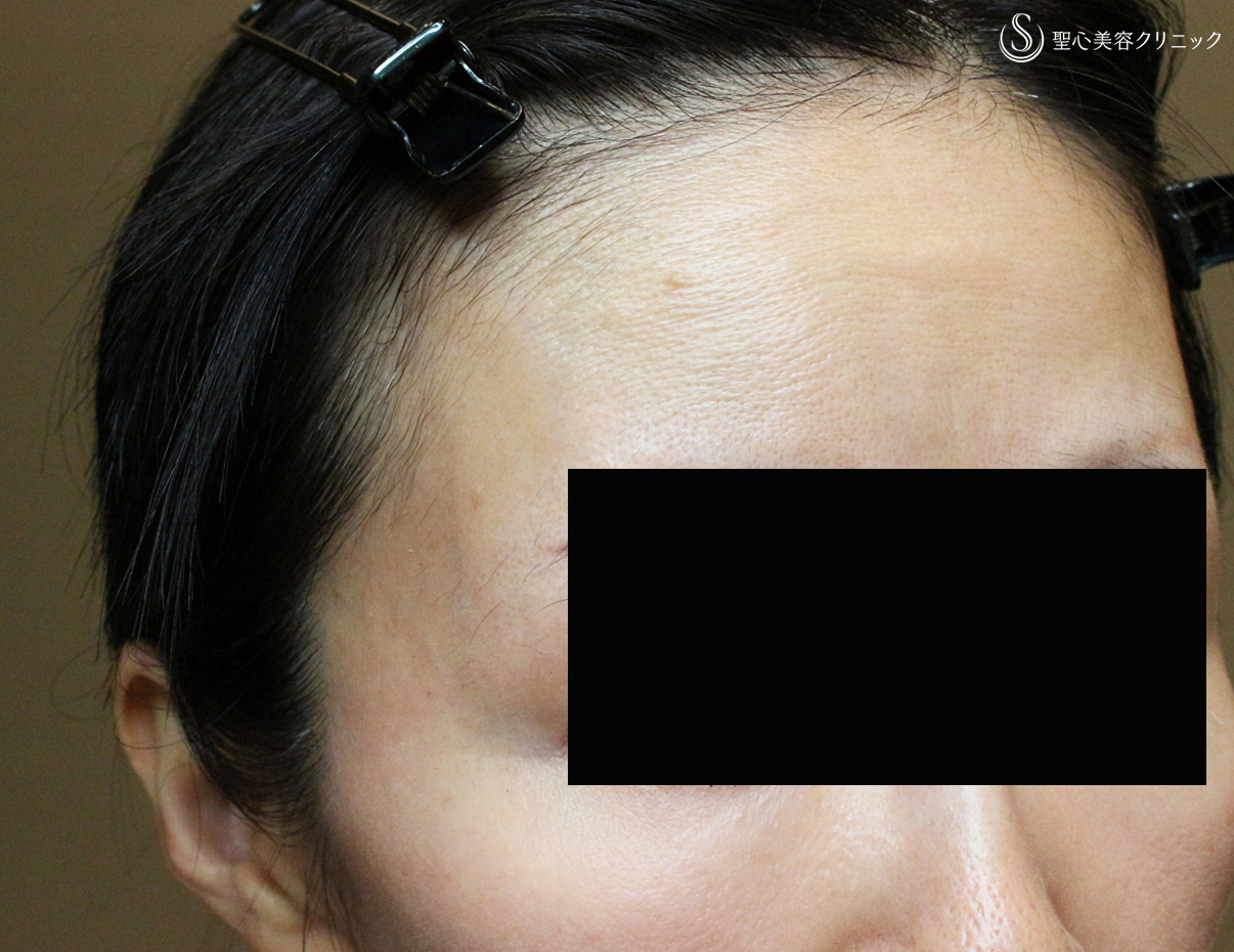 【40代女性・こめかみで若返り＆リフト効果】プレミアムPRP皮膚再生療法（10ヶ月後） After 
