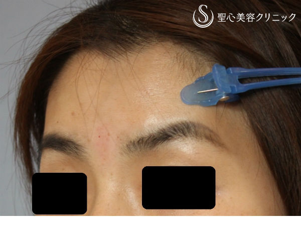 【30代女性・額の若返り】ヒアルロン酸注入（1ヶ月後） After 