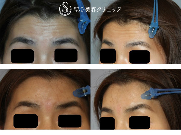 【30代女性・額の若返り】ヒアルロン酸注入（1ヶ月後） After 