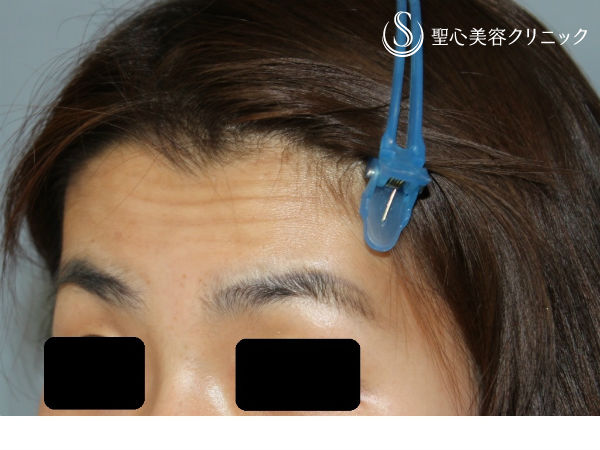 【30代女性・額の若返り】ヒアルロン酸注入（1ヶ月後） Before 