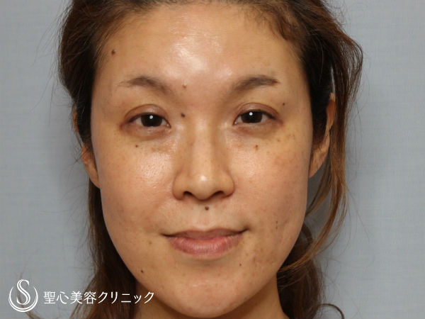 【40代女性・顔全体の疲れた印象を改善】プレミアムPRP皮膚再生療法（1ヶ月後） After 