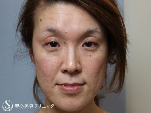 【40代女性・顔全体の疲れた印象を改善】プレミアムPRP皮膚再生療法（1ヶ月後） Before 