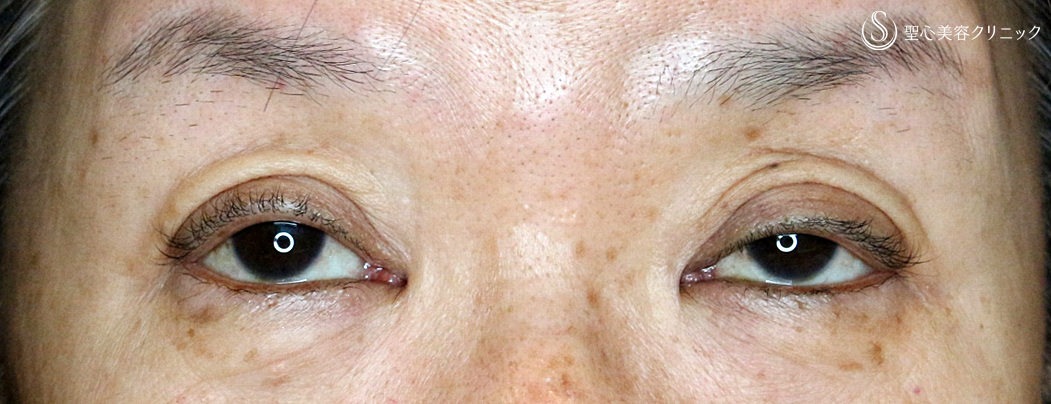 【60代女性・眼瞼下垂（埋没法）＆同時に二重】切らない眼瞼下垂+α法（6ヶ月後）札幌院 Before 