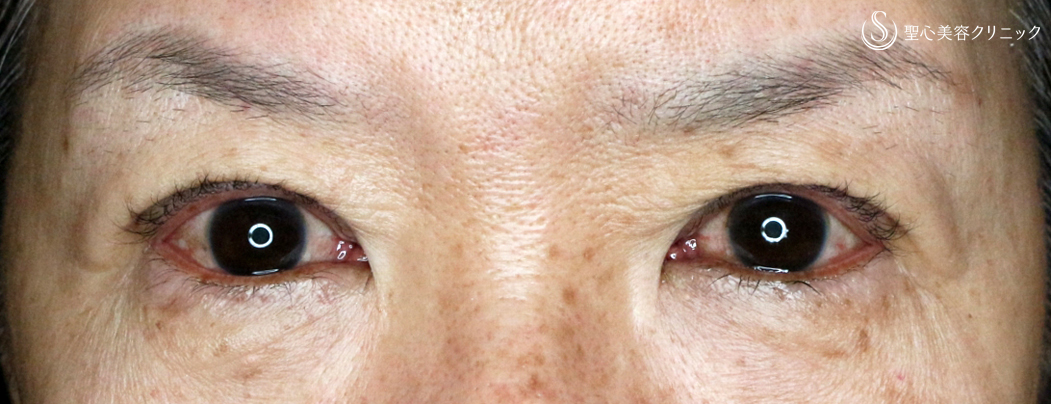 【60代女性・眼瞼下垂（埋没法）＆同時に二重】切らない眼瞼下垂+α法（6ヶ月後）札幌院 Before 