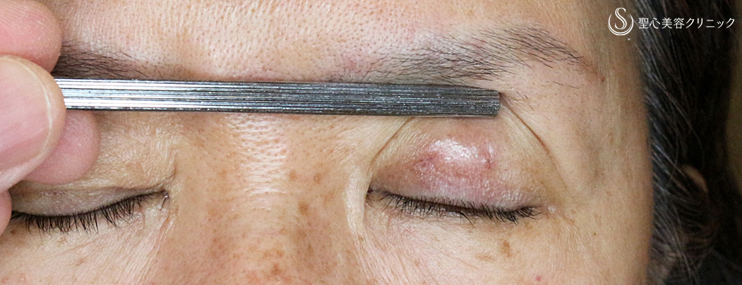 【60代女性・眼瞼下垂（埋没法）＆同時に二重】切らない眼瞼下垂+α法（6ヶ月後）札幌院 After 