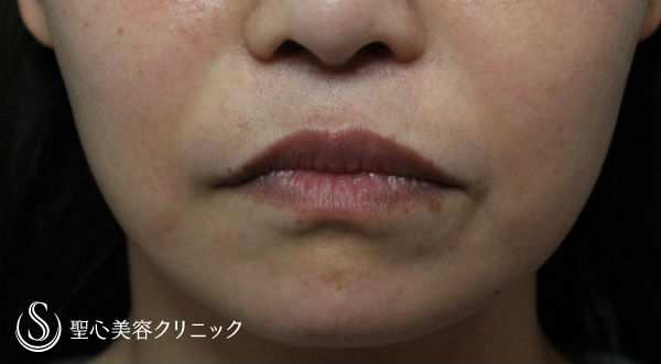 【30代女性・下がった口角を上に】口角挙上（術後2ヶ月） Before 