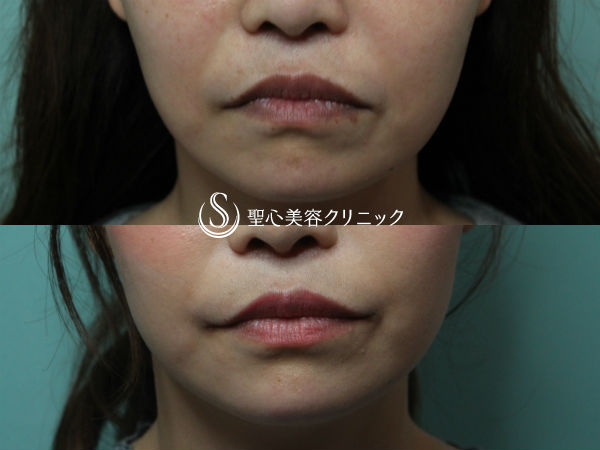 【30代女性・下がった口角を上に】口角挙上（術後2ヶ月） After 