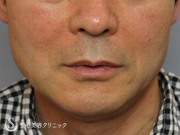 【50代男性・頬のたるみとほうれい線のシワを改善】アンカーリフト＆プレミアムPRP（施術直後） Before 