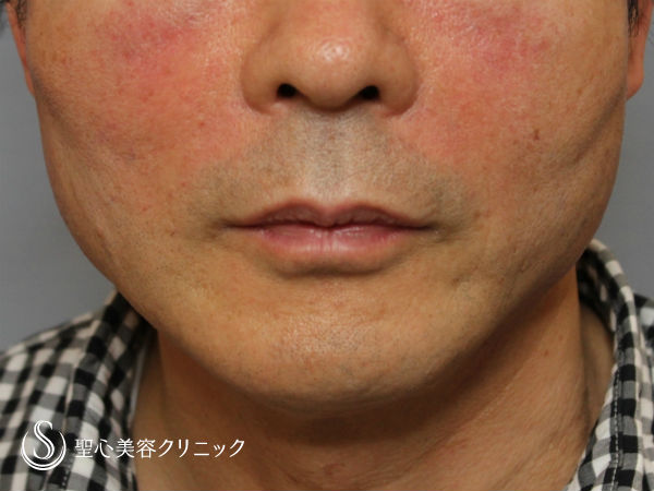 【50代男性・頬のたるみとほうれい線のシワを改善】アンカーリフト＆プレミアムPRP（施術直後） After 
