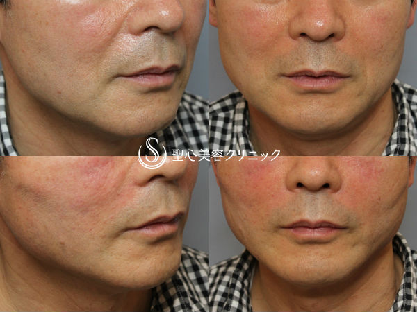【50代男性・頬のたるみとほうれい線のシワを改善】アンカーリフト＆プレミアムPRP（施術直後） After 