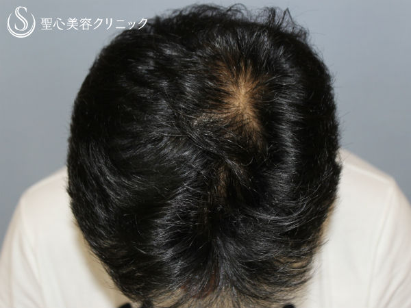 【40代男性・薄毛を改善】毛髪治療（外用薬と内服薬併用）プロペシア（3ヶ月後） After 