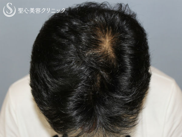 40代男性 薄毛を改善 毛髪治療 外用薬と内服薬併用 プロペシア 3ヶ月後 症例写真 美容整形 美容外科なら聖心美容クリニック 40代男性 薄毛を改善 毛髪治療 外用薬と内服薬併用 プロペシア 3ヶ月後 症例写真 美容整形 美容外科なら聖心美容クリニック