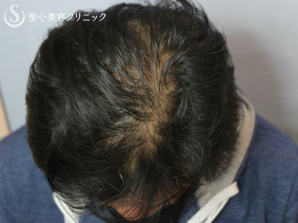 【40代男性・薄毛を改善】毛髪治療（外用薬と内服薬併用）プロペシア（3ヶ月後） Before 