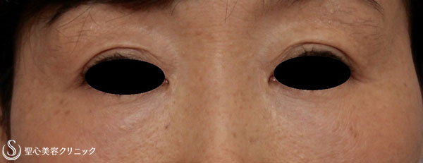 【女性・目の上のくぼみ、目の下のたるみの改善】プレミアムPRP皮膚再生療法 After 