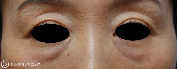 【女性・目の上のくぼみ、目の下のたるみの改善】プレミアムPRP皮膚再生療法 Before 