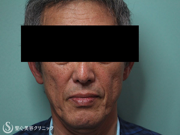 【60代男性・頬のコケの改善】プレミアムPRP皮膚再生療法（1ヶ月後） Before 