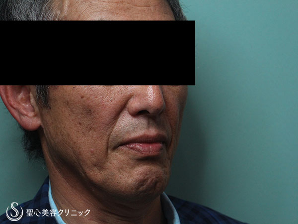 【60代男性・頬のコケの改善】プレミアムPRP皮膚再生療法（1ヶ月後） Before 