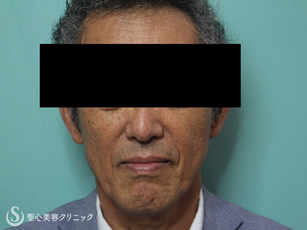 【60代男性・頬のコケの改善】プレミアムPRP皮膚再生療法（1ヶ月後） After 