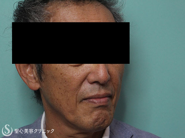 【60代男性・頬のコケの改善】プレミアムPRP皮膚再生療法（1ヶ月後） After 