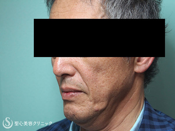 【60代男性・頬のコケの改善】プレミアムPRP皮膚再生療法（1ヶ月後） Before 