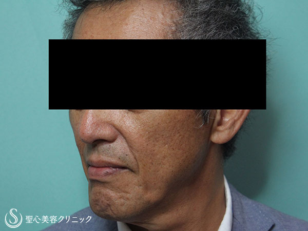 【60代男性・頬のコケの改善】プレミアムPRP皮膚再生療法（1ヶ月後） After 