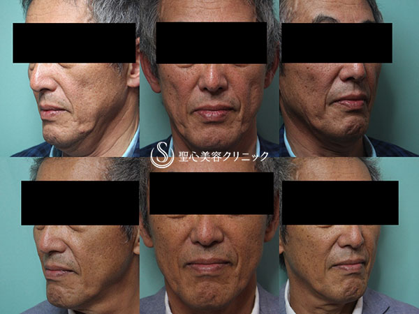【60代男性・頬のコケの改善】プレミアムPRP皮膚再生療法（1ヶ月後） After 