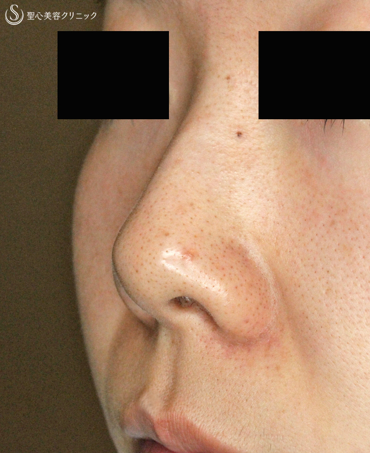 【20代女性・団子鼻＆鼻の穴が見える】鼻尖縮小術＆小鼻縮小術+α法（2年後）札幌院 Before 