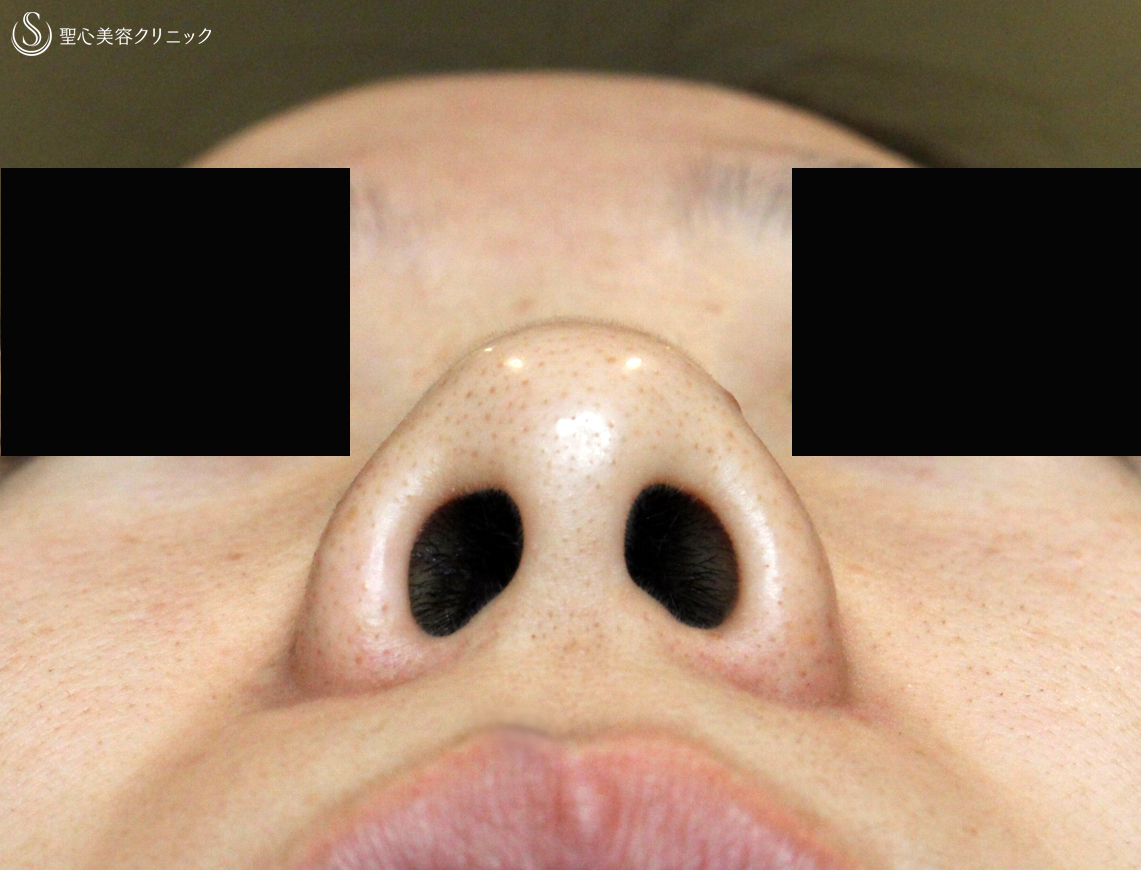 【20代女性・団子鼻＆鼻の穴が見える】鼻尖縮小術＆小鼻縮小術+α法（2年後）札幌院 Before 