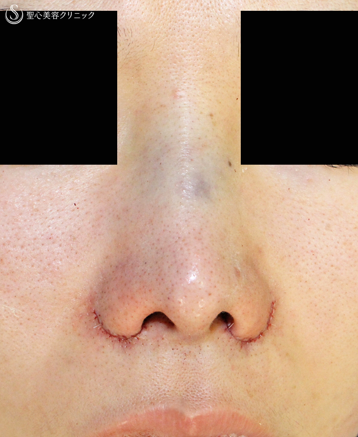【20代女性・団子鼻＆鼻の穴が見える】鼻尖縮小術＆小鼻縮小術+α法（2年後）札幌院 Before 