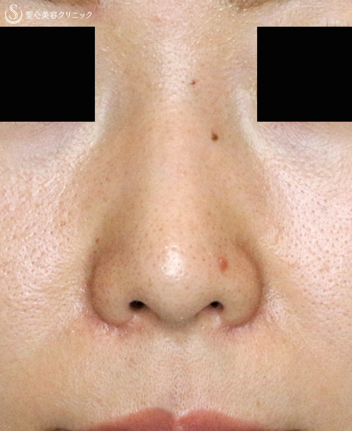 【20代女性・団子鼻＆鼻の穴が見える】鼻尖縮小術＆小鼻縮小術+α法（2年後）札幌院 After 