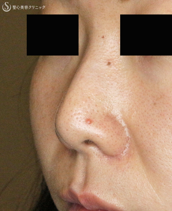 【20代女性・団子鼻＆鼻の穴が見える】鼻尖縮小術＆小鼻縮小術+α法（2年後）札幌院 After 