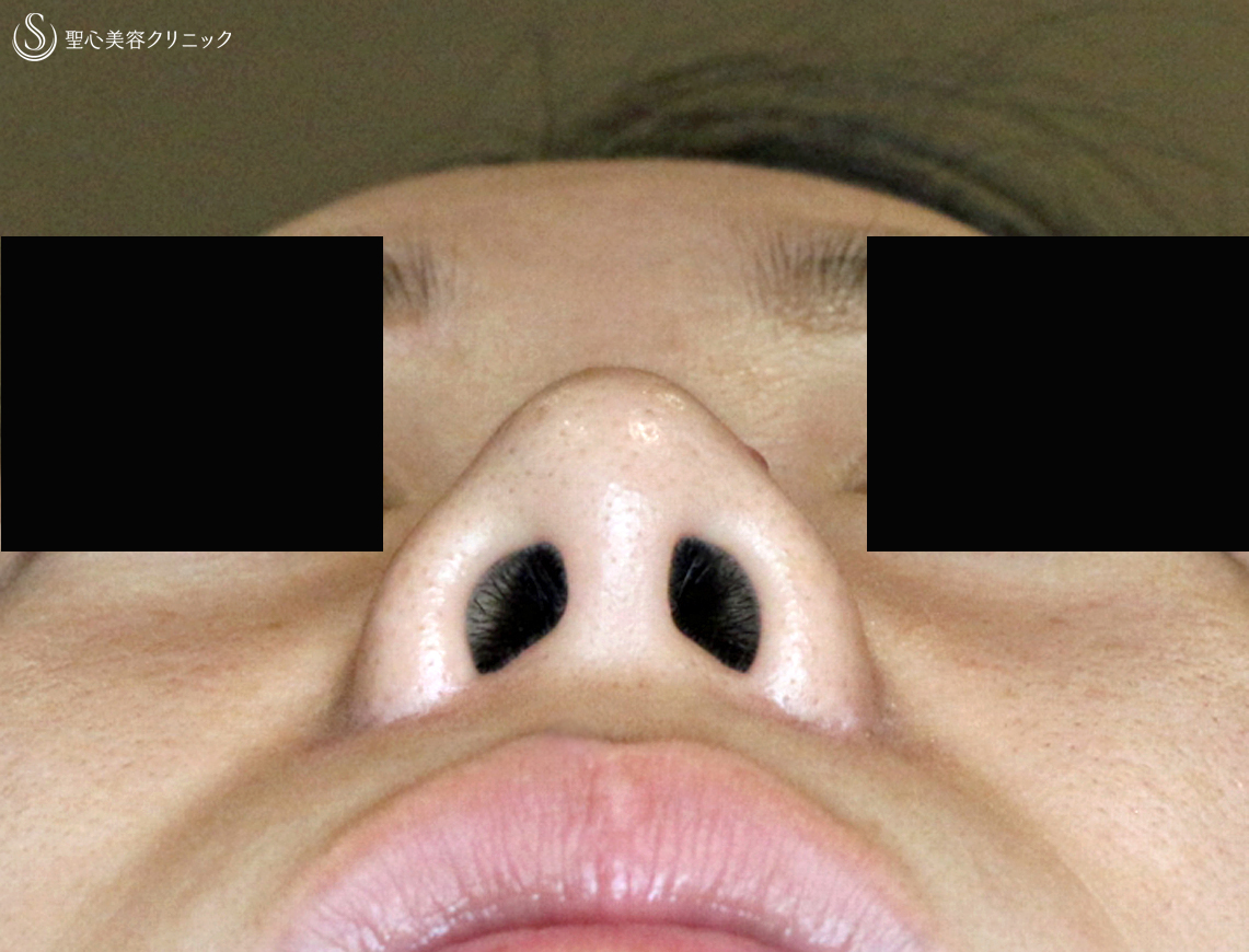 【20代女性・団子鼻＆鼻の穴が見える】鼻尖縮小術＆小鼻縮小術+α法（2年後）札幌院 After 