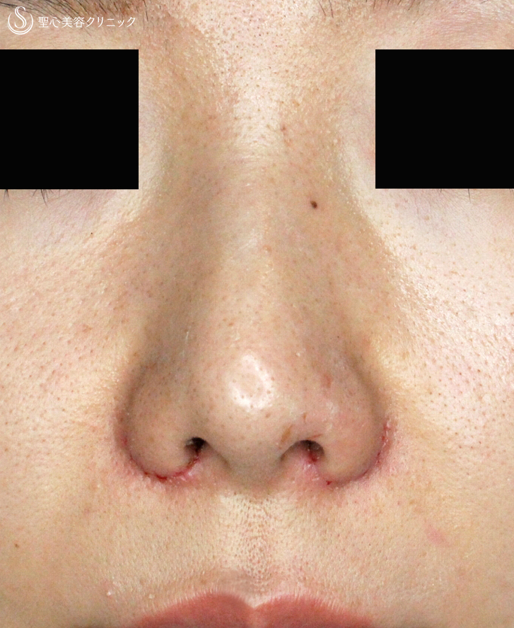 【20代女性・団子鼻＆鼻の穴が見える】鼻尖縮小術＆小鼻縮小術+α法（2年後）札幌院 After 