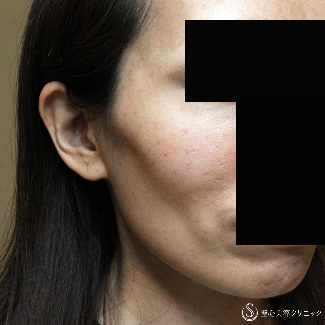 【40代女性・頬のコケ＆凹みを治す】プレミアムPRP皮膚再生療法（3年後） Before 