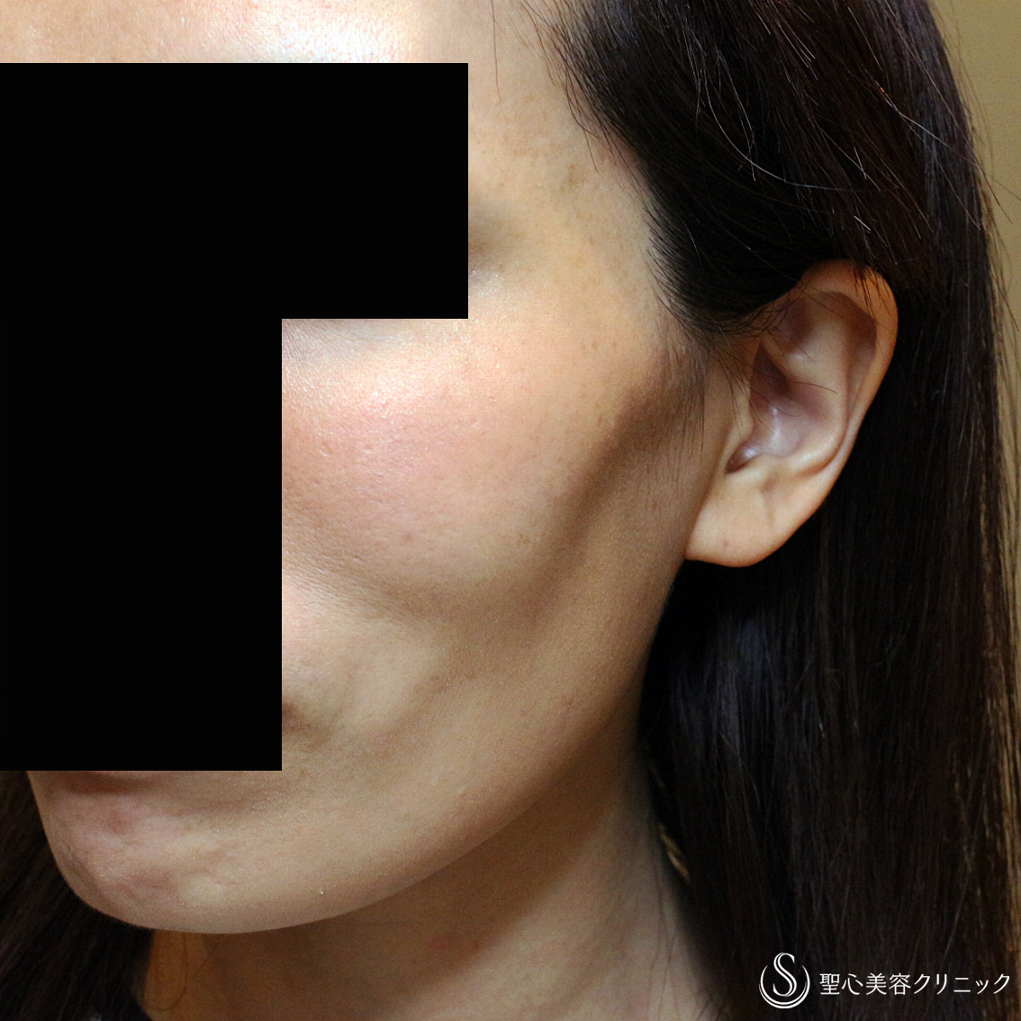 【40代女性・頬のコケ＆凹みを治す】プレミアムPRP皮膚再生療法（3年後） Before 