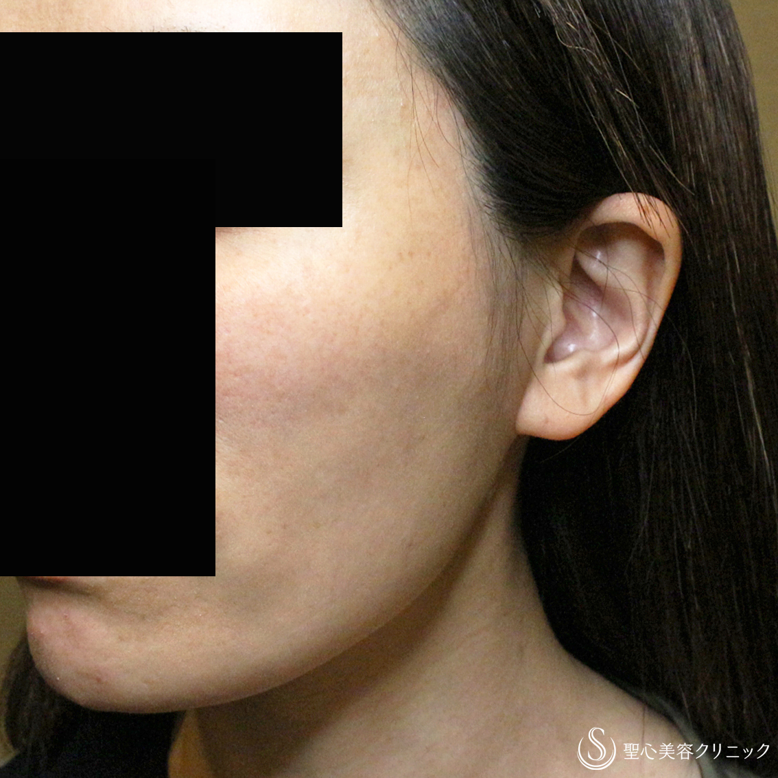 【40代女性・頬のコケ＆凹みを治す】プレミアムPRP皮膚再生療法（3年後） After 