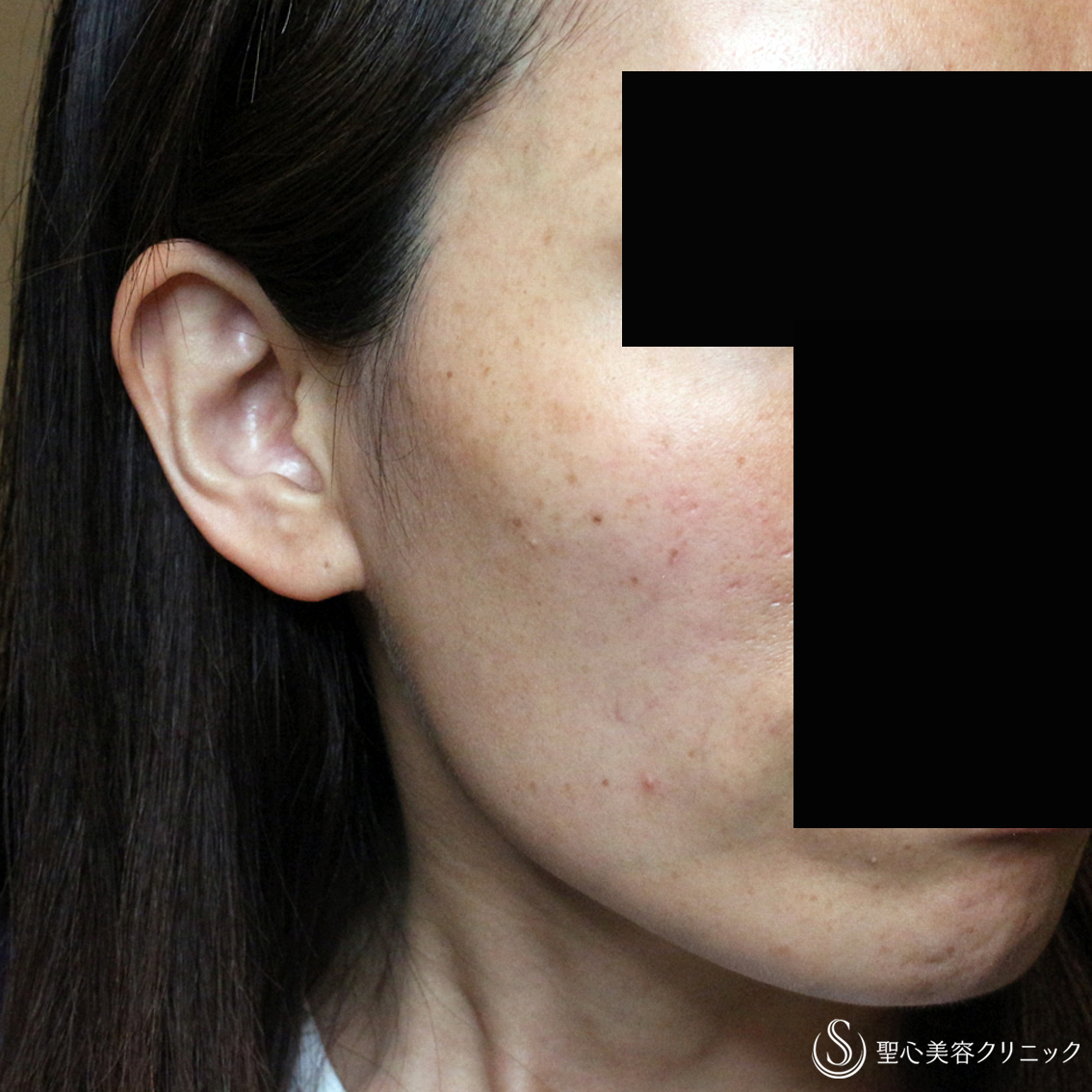 【40代女性・頬のコケ＆凹みを治す】プレミアムPRP皮膚再生療法（3年後） After 