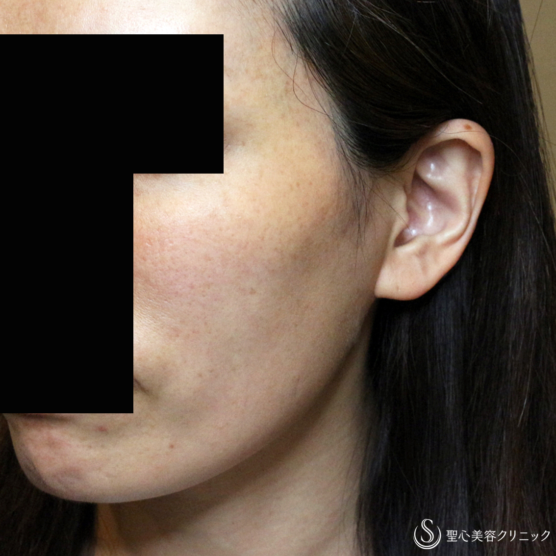 【40代女性・頬のコケ＆凹みを治す】プレミアムPRP皮膚再生療法（3年後） After 