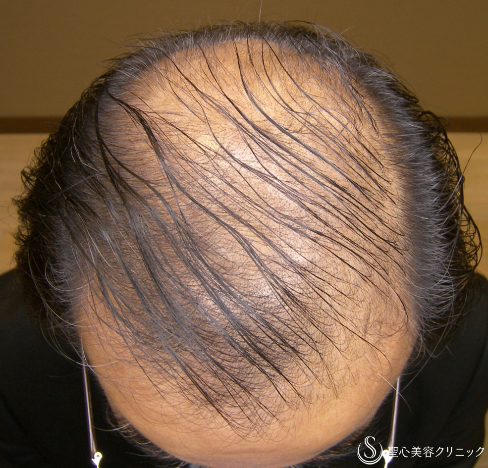 【50代男性・AGA】グロースファクター毛髪再生療法（32回3年半） Before 