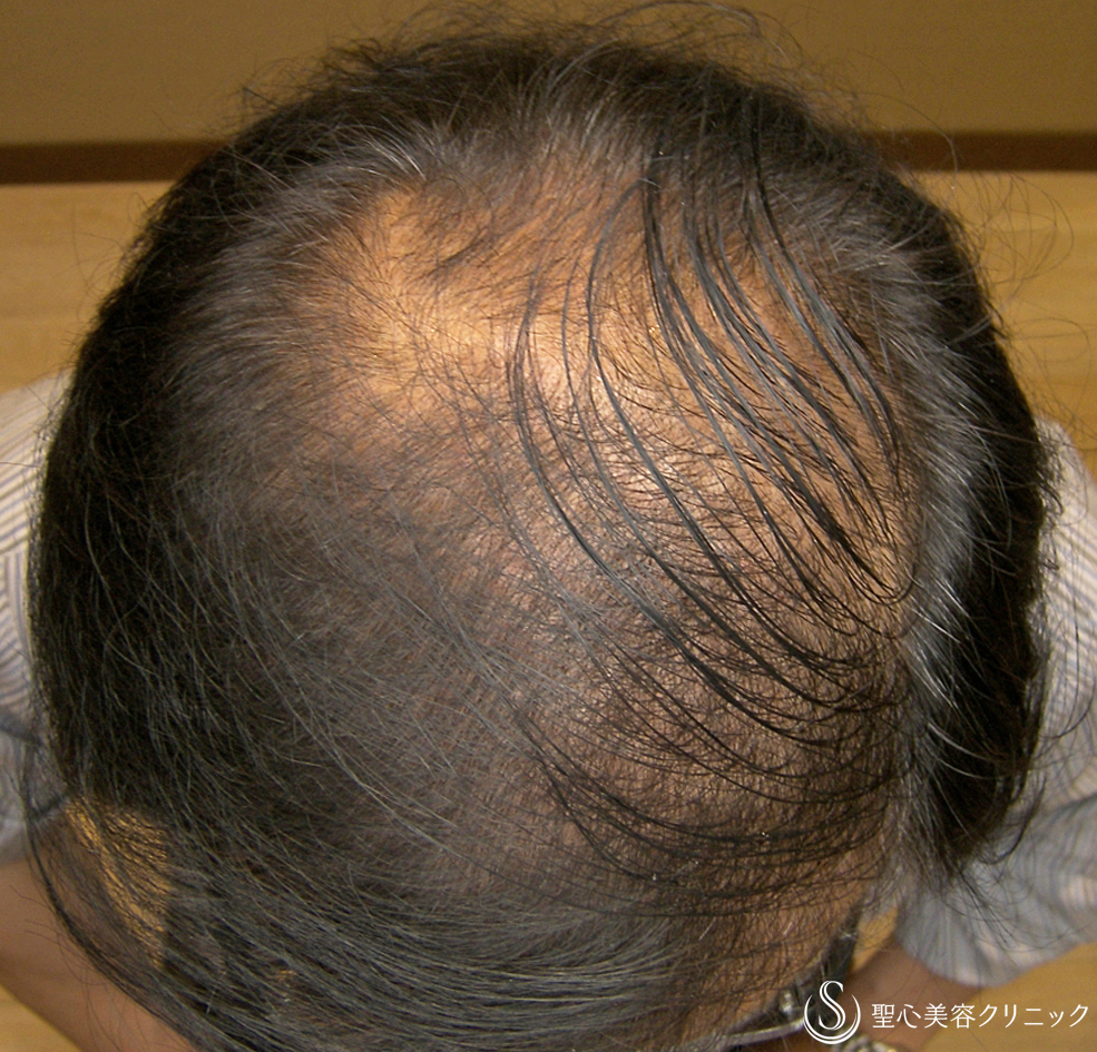 【50代男性・AGA】グロースファクター毛髪再生療法（32回3年半） After 