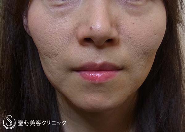 【女性・頬のコケ＆毛穴・にきびの改善】イントラセル＆プレミアムPRP（5年後） Before 