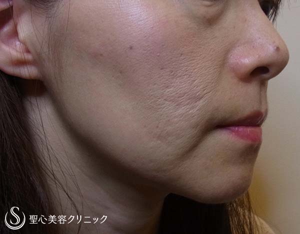 【女性・頬のコケ＆毛穴・にきびの改善】イントラセル＆プレミアムPRP（5年後） Before 