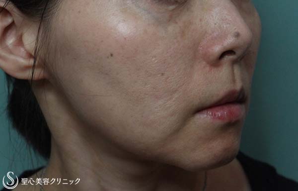 【女性・頬のコケ＆毛穴・にきびの改善】イントラセル＆プレミアムPRP（5年後） After 