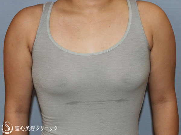 【20代女性・性同一性障害（FTM）】乳腺切除術+脂肪吸引（3ヶ月後） Before 