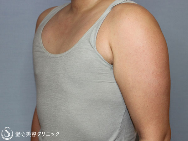 【20代女性・性同一性障害（FTM）】乳腺切除術+脂肪吸引（3ヶ月後） After 