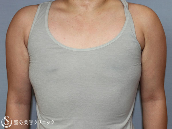 【20代女性・性同一性障害（FTM）】乳腺切除術+脂肪吸引（3ヶ月後） After 