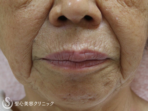 【80代女性・口周りの若返り】プレミアムPRP皮膚再生療法（1年後） Before 