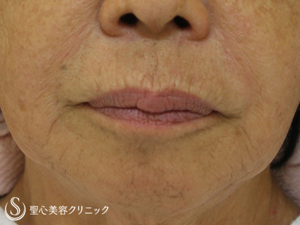 【80代女性・口周りの若返り】プレミアムPRP皮膚再生療法（1年後） After 